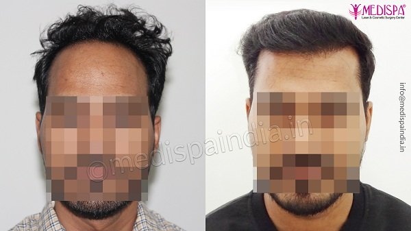 How To Prepare For A Hair Transplant Procedure