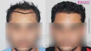 When Do I Need Hair Transplant?