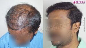How To Define The Success of A Hair Transplant Procedure?