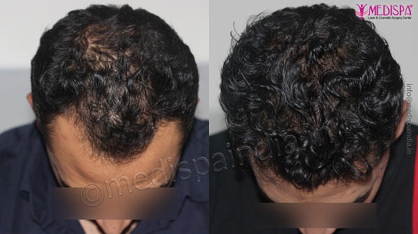 Who Is The Suitable Candidate For Hair Transplantation?