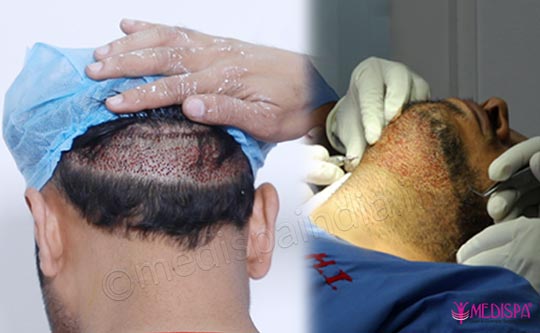 Explain The Terms “Donor Area” And “Recipient Area” in Hair Transplantation