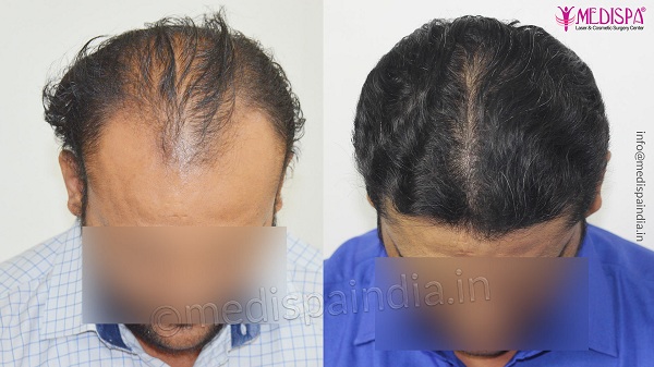 What Are The Parameters For An Ideal Hair Transplant Candidate?