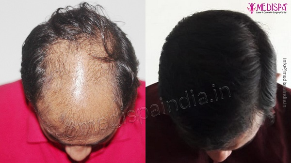 What Is Crown (Vertex) Hair Restoration? Is It Successful?
