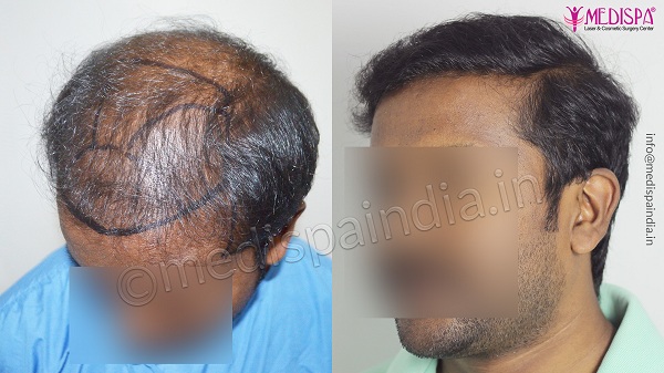 Explain The Importance And Types of Hair Transplant Methods