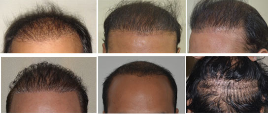 Why Hair Transplant Repair Can Be A Good Idea After A Bad Hair Transplant?