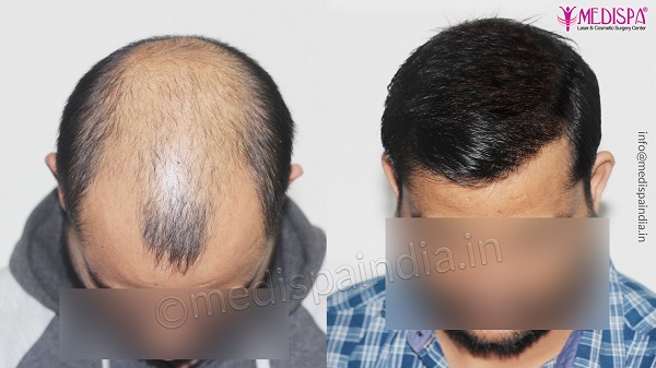 Major Factors That Determine The Cost of Hair Transplant Treatment