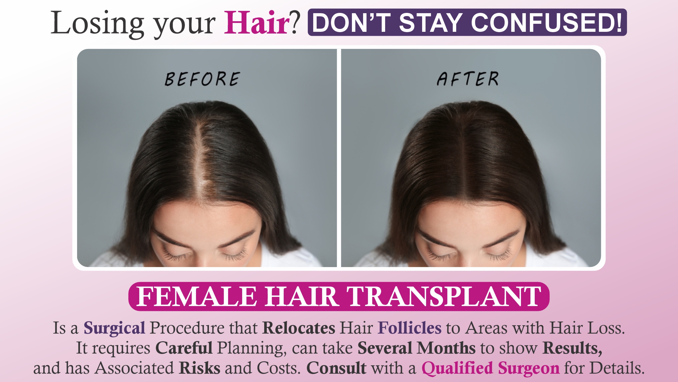 Hair Loss in Women: How Hair Restoration Can Help?