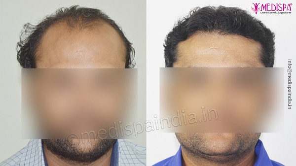 How Does Hair Transplant Help In Enhancing Your Appearance?