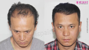 Should I Undergo Second Hair Transplant After The Unsuccessful Surgery?