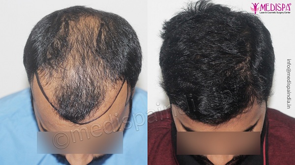 Things To Know About Male Hair Transplant