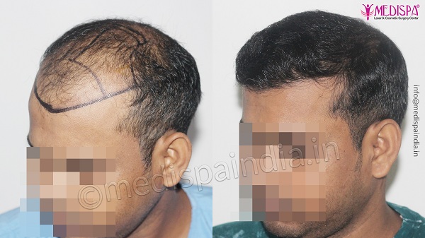 How to Identify The Best Surgeon For Hair Transplant Surgery?