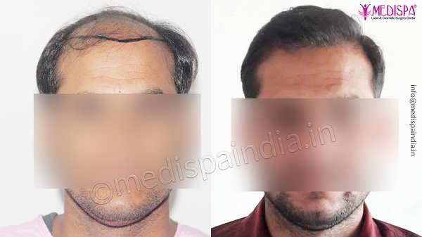 Before And After Hair Transplant – Step By Step Guide