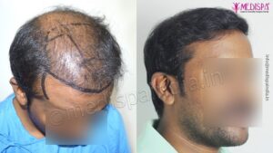 How To Get Painless Hair Transplant Treatment With Best Results?