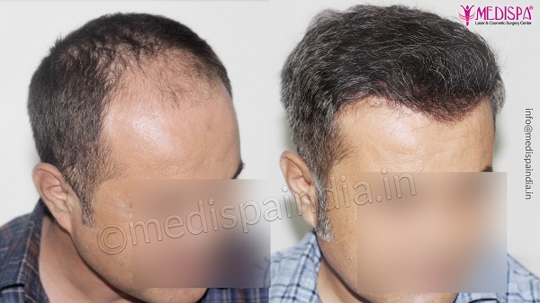 How To Research About The Clinic Before Hair Transplant Surgery?