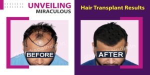 How To Get Over The Issue Of Pattern Baldness By Hair Transplant?