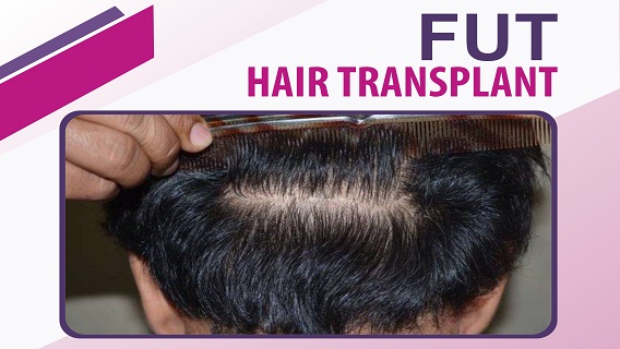 Explain The Functioning of FUT Hair Transplant Technique