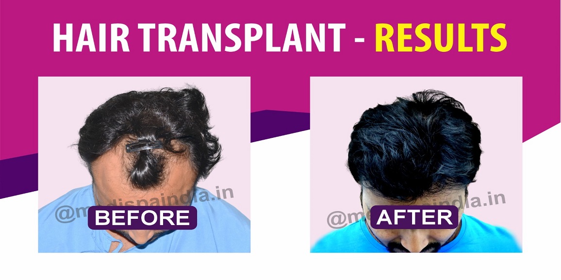 Is One Hair Transplant Treatment Enough To Last For Lifetime?