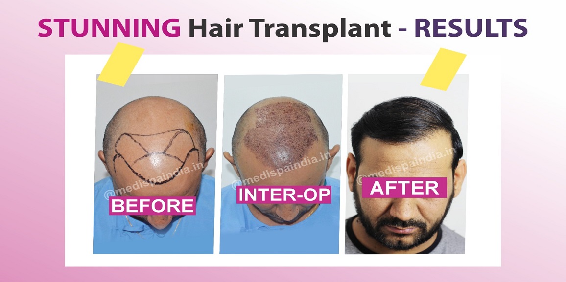 What is The Success Rate of Hair Transplant?