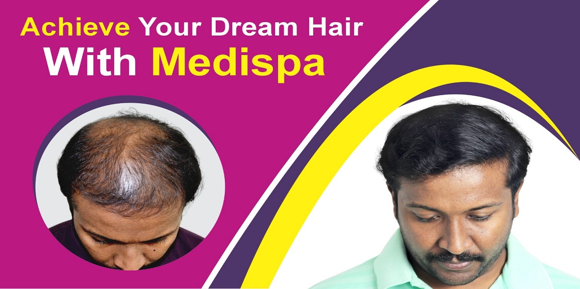 Is Hair Transplant A Better Option Than Medication For Hair Loss?