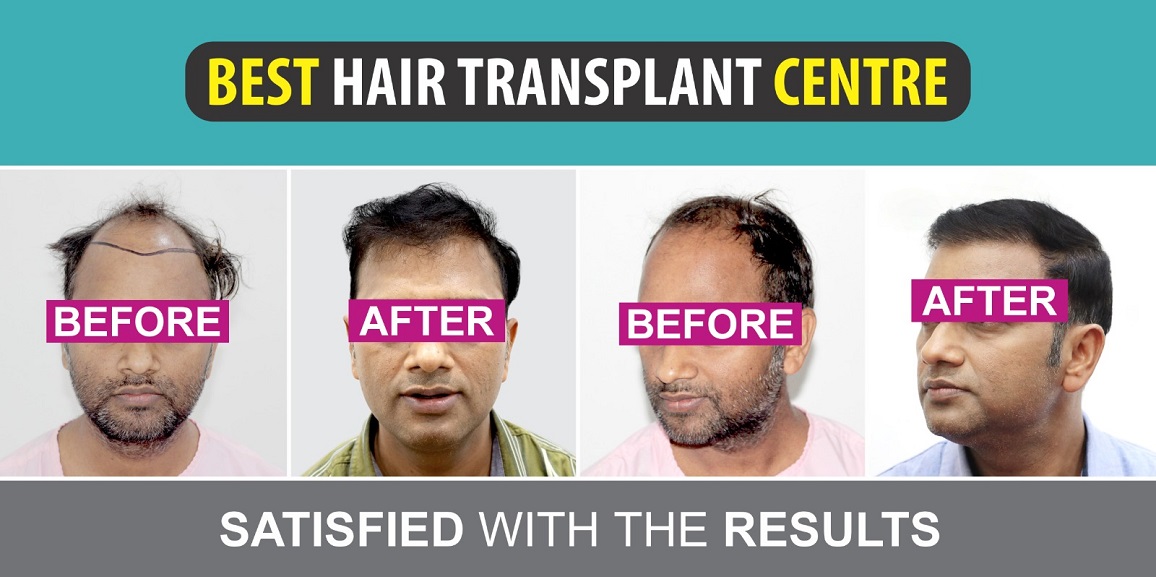 How To Maximize Hair Growth Rate After Hair Transplant Treatment?