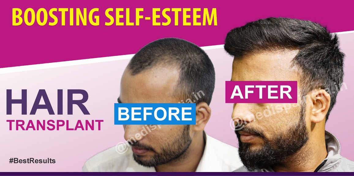 Why To Choose The Experienced Doctor For Hair Restoration?