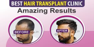 Is Choosing Hair Transplant Can Be Considered As The Right Choice?