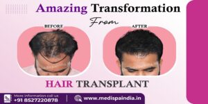 Transforming Your Appearance With Hair Transplant: A Complete Overview