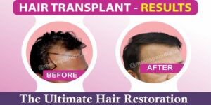Preparing For Your Hair Transplant: What To Expect?