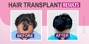 What Are The Various Hair Transplant Options And Their Significance?