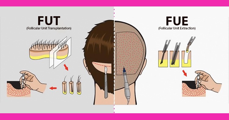 Hair Transplantation Techniques: FUE VS FUT