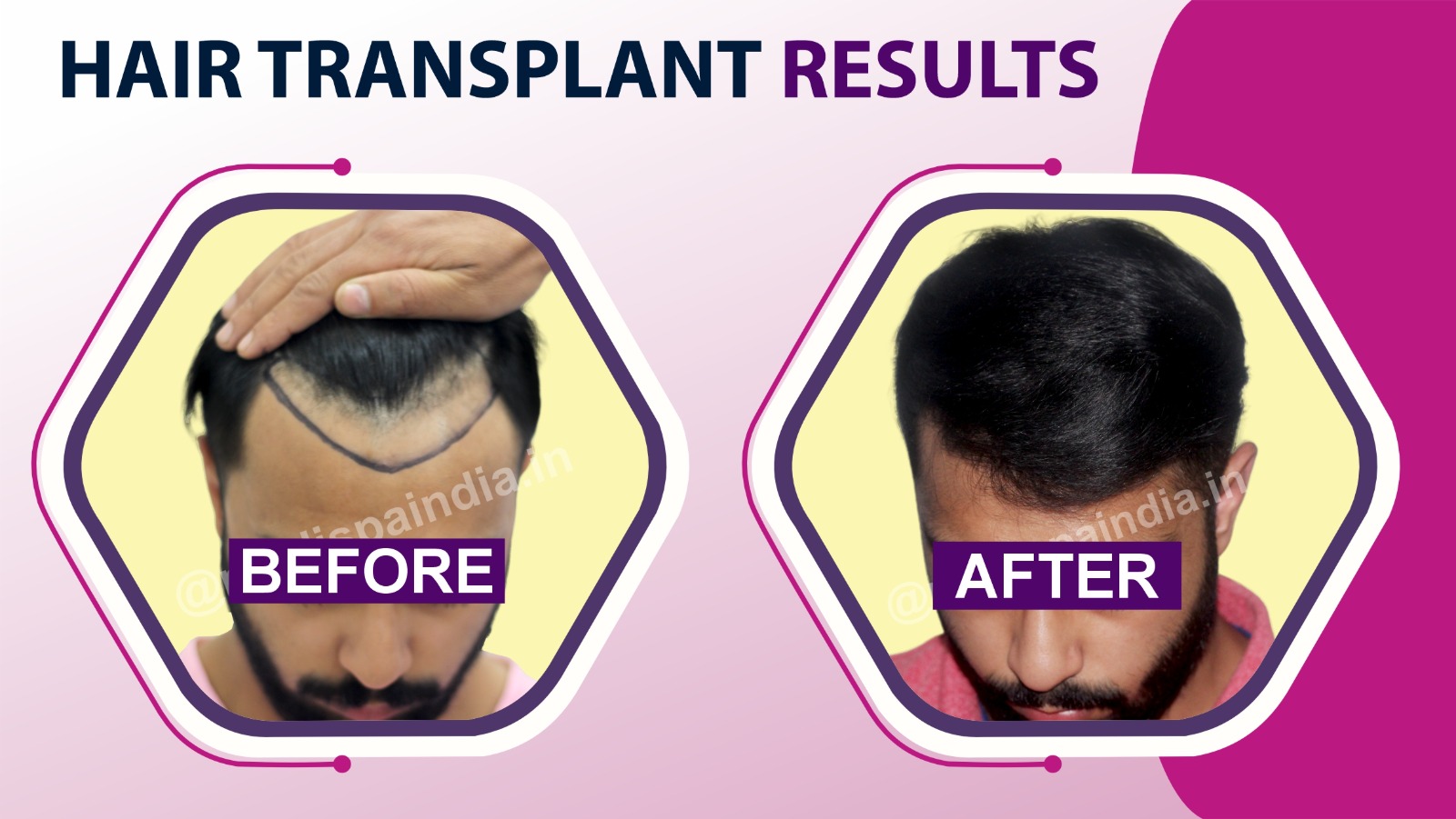 Is Hair Transplant The Best Option To Stop Receding Hairline?