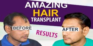 Guidelines To Choose The Best Hair Transplant Clinic in Rajasthan