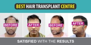 Can Hair Transplant Surgery Provide Natural Hair Growth?