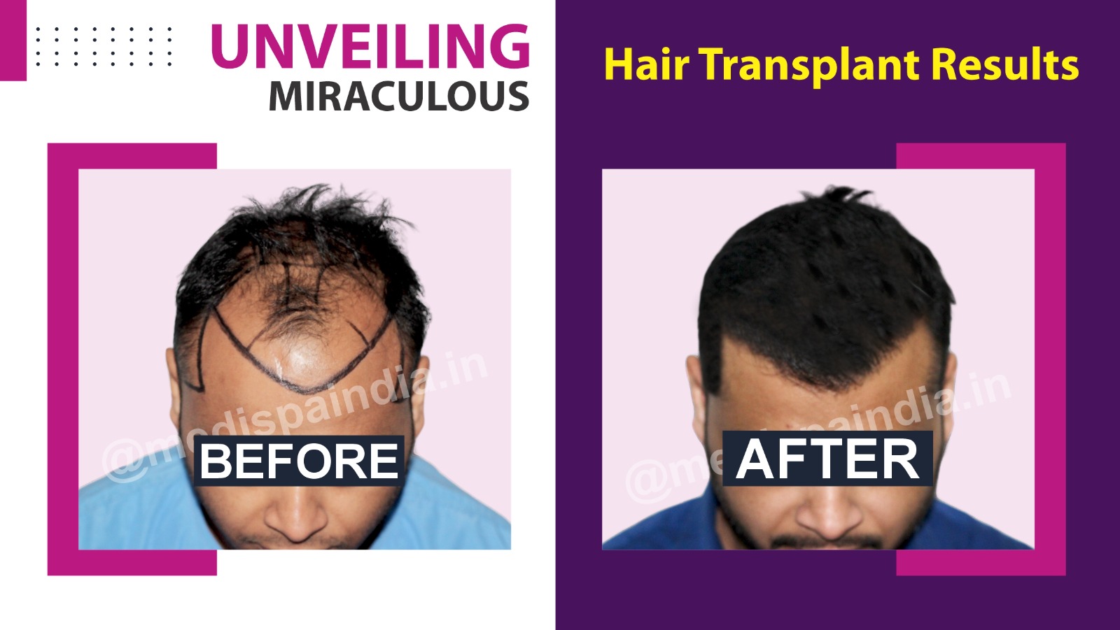 Explain The Qualities And Responsibilities Of A Hair Transplant Surgeon