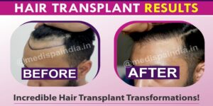 How To Improve Hair Density With Hair Transplantation?