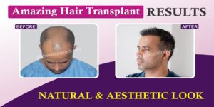 How Can Hair Transplant Help In Achieving Aesthetic Hairline?