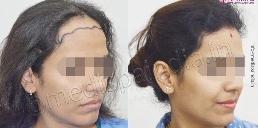 jaipur hair transplant cost india
