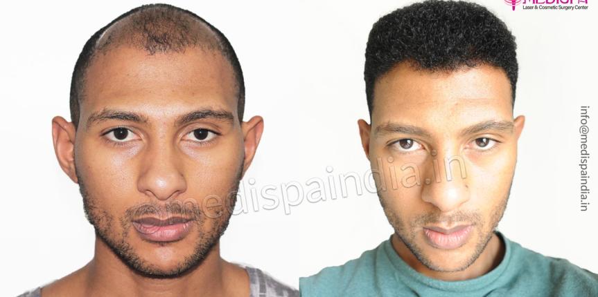curly hair transplant results