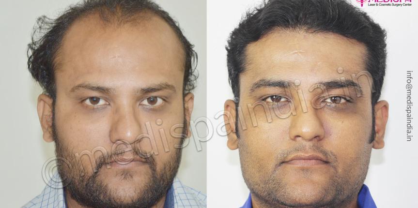 hair transplant in bangladesh