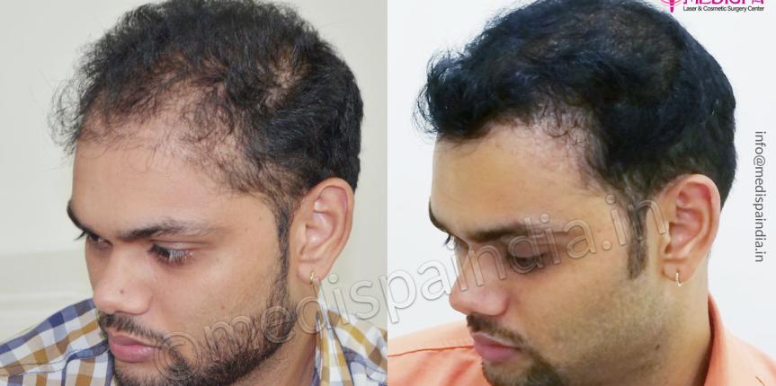 wrong hair transplant correction mumbai