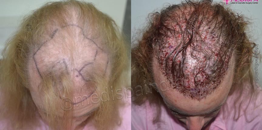 hair restoration in australia