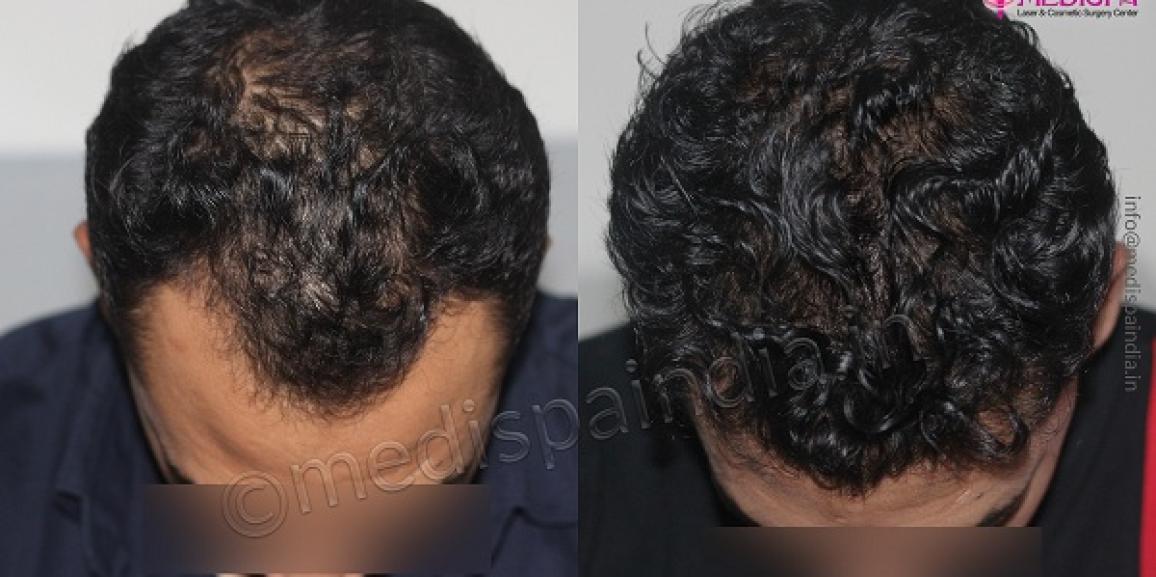 What Are The Common Concerns While Considering Hair Transplant?