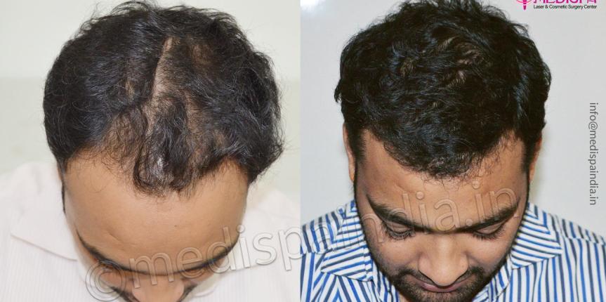 best hair transplant clinics in kolkata