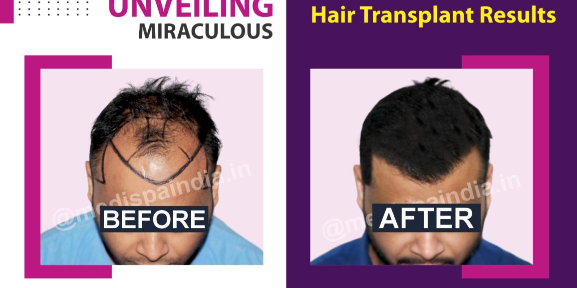 Explain The Qualities And Responsibilities Of A Hair Transplant Surgeon