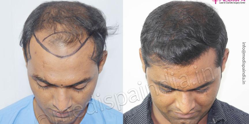 combination fut fue hair transplant india