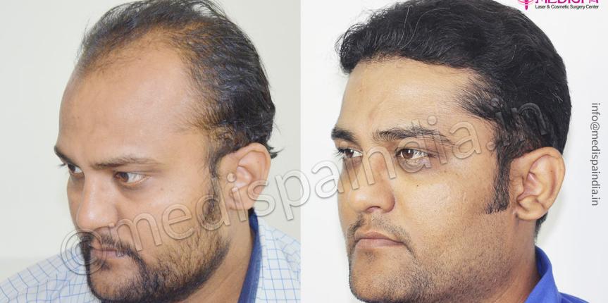 hair transplant cost in bangladesh