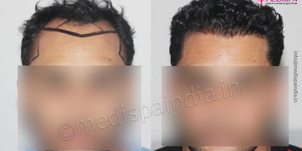 How To Find The Best Hair Transplant Clinic In Jaipur