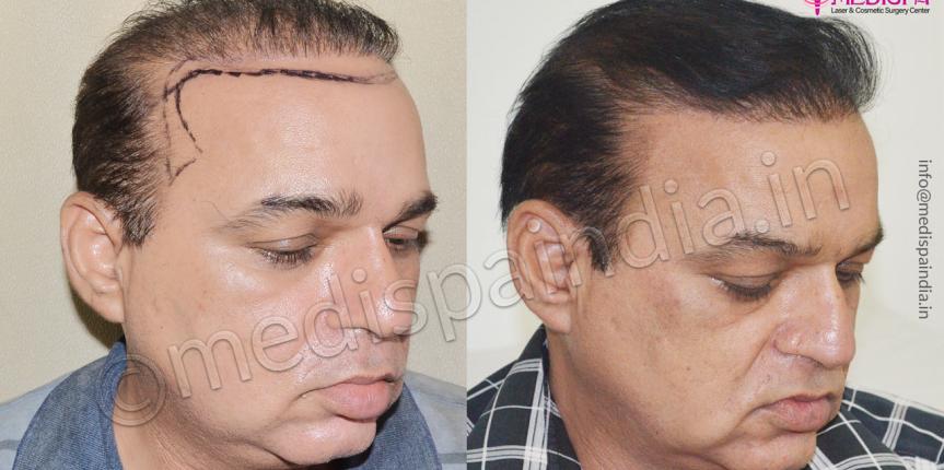 bad hair transplant repair jaipur rajasthan