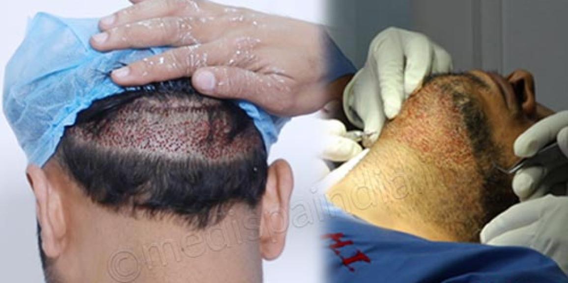 Explain The Terms “Donor Area” And “Recipient Area” in Hair Transplantation