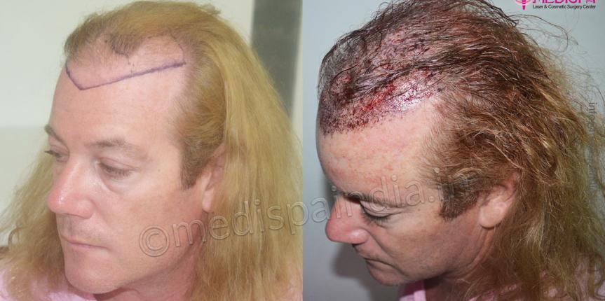 hair restoration results australia